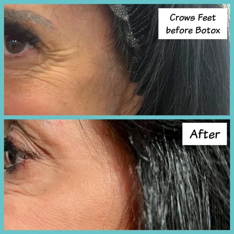 Botox treatment for crow's feet, before and after at Ageless Health Institute