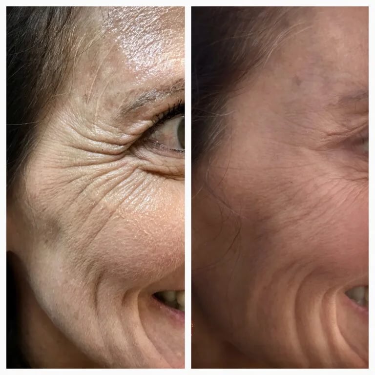 Botox treatment for crow's feet, before and after at Ageless Health Institute