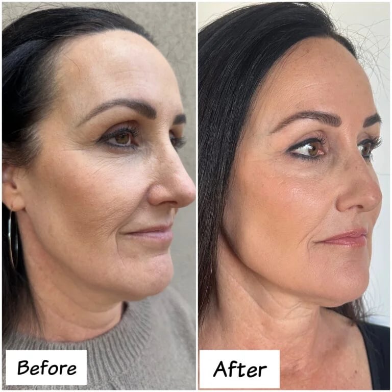 Jawline, cheek and chin filler, before and after at Ageless Health Institute
