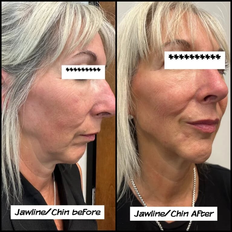Jawline and chin filler, before and after at Ageless Health Institute
