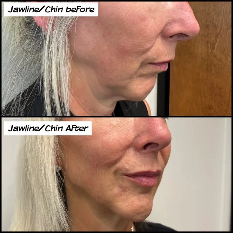 Jawline and chin filler, before and after at Ageless Health Institute