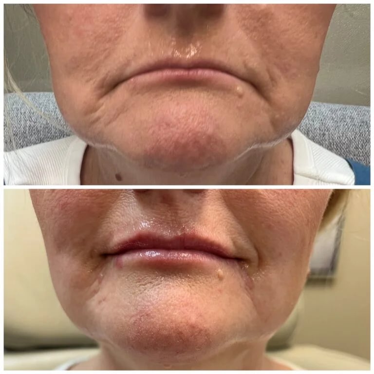 Lip filler, before and after at Ageless Health Institute
