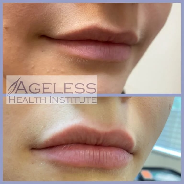 Lip filler, before and after at Ageless Health Institute