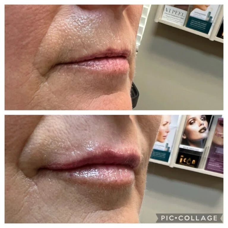 Lip filler, before and after at Ageless Health Institute