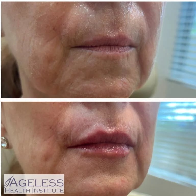 Lip filler, before and after at Ageless Health Institute