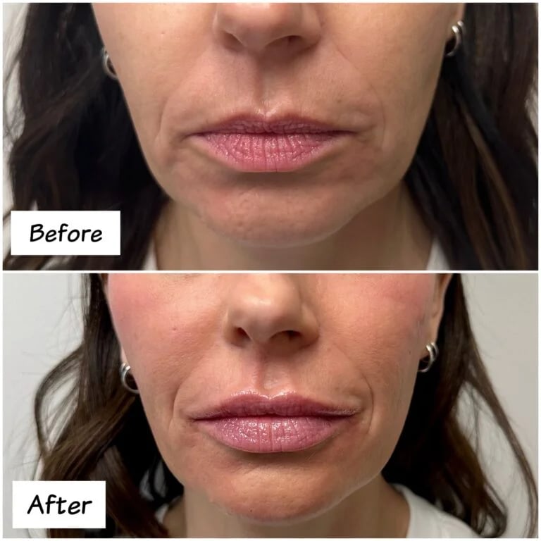 Lip filler, before and after at Ageless Health Institute