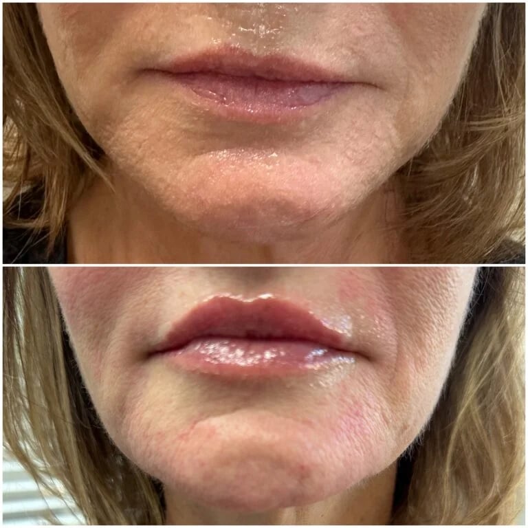 Lip filler, before and after at Ageless Health Institute